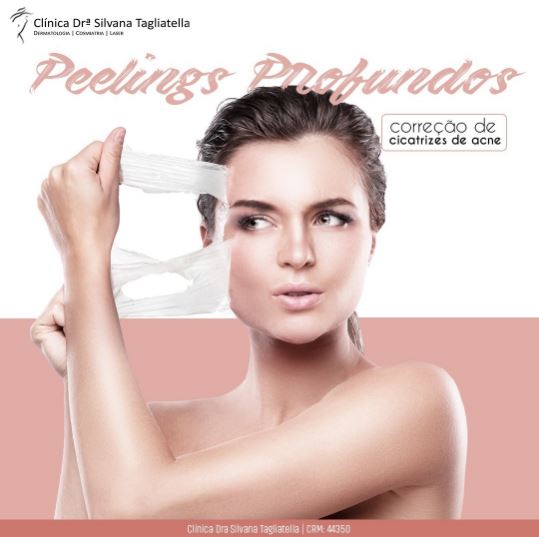 Peelings profundos: correção de cicatrizes de acne