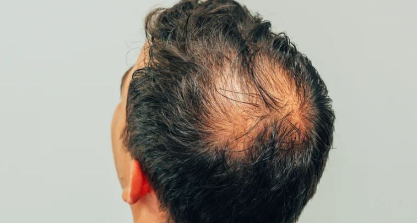 Conheça os tratamentos para Calvície (Alopecia)