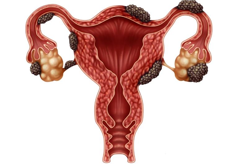 Consulta CID 10 – Endometriose: saiba mais sobre a doença